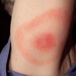 Lyme Disease rash